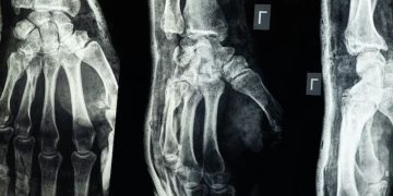 চীনে বিজ্ঞানীদের নতুন আবিষ্কার, ৩ মিনিটেই জোড়া লাগবে ভাঙা হাড়