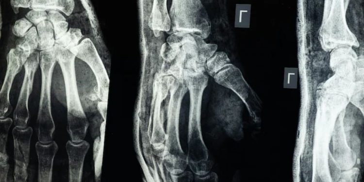 চীনে বিজ্ঞানীদের নতুন আবিষ্কার, ৩ মিনিটেই জোড়া লাগবে ভাঙা হাড়