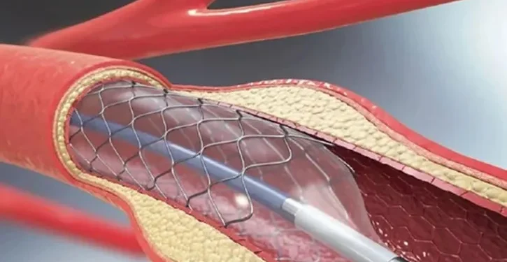 কার্যকর আজ থেকে, হার্টের ১০ ধরনের রিংয়ের দাম কমলো