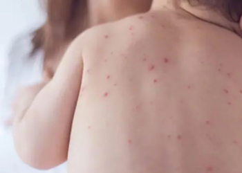 ২৪ ঘণ্টায় হাম ও হামের উপসর্গ নিয়ে ১০ শিশুর মৃত্যু, আক্রান্ত আরও ১৪২৮