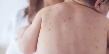 ২৪ ঘণ্টায় হাম ও হামের উপসর্গ নিয়ে ১০ শিশুর মৃত্যু, আক্রান্ত আরও ১৪২৮