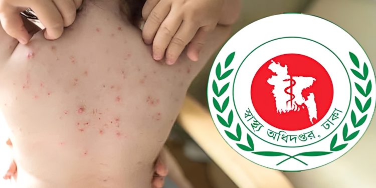 হাম ও উপসর্গে আরও ৯ শিশুর মৃত্যু