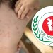 হাম ও উপসর্গে আরও ৯ শিশুর মৃত্যু